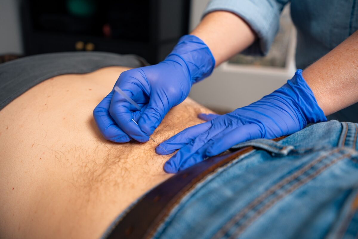 Dry needling at 30A Valley Wellness